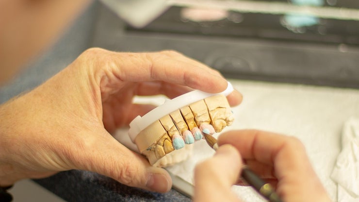 A dentist creates crowns for dental implants.