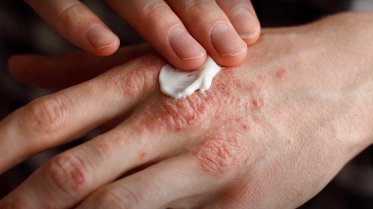 Psoriasis